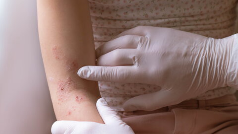 Hände des Arztes untersuchen Ekzeme