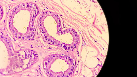 Mikroskopische Aufnahme von Hidradenitis suppurativa in axillären Massengeweben. zeigt Hyperplasie des follikulären Epithels, dermales Entzündungszellinfiltrium vorhanden