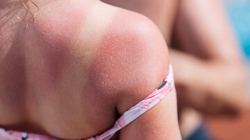 Geeignet für die Behandlung von leichten Verbrennungen oder Sonnenbrand ist das Bepanthen® Kühlendes Schaumspray. Bild: Adobe Stock