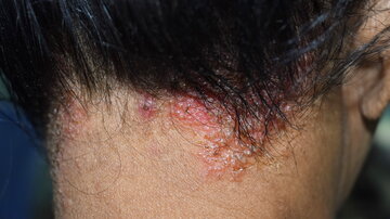 Seborrhoische Dermatitis oder Hautpilzinfektion an der Kopfhaut einer südostasiatischen, erwachsenen Patientin aus Myanmar.