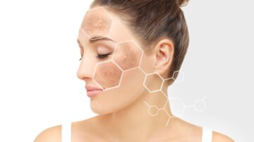 Tranexansäure plus Lasertherapie bei Melasma