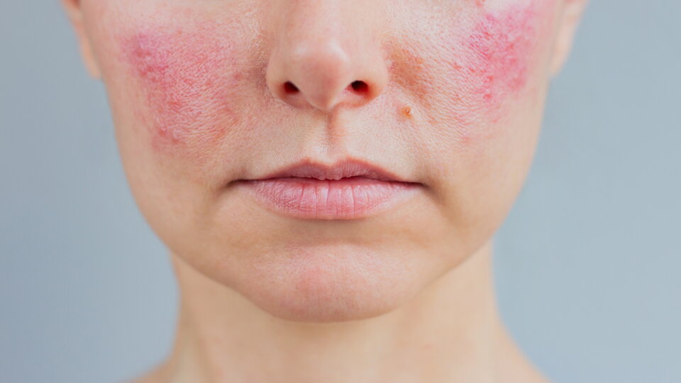 Porträt einer jungen Frau, die im akuten Stadium an Rosacea im Gesicht leidet