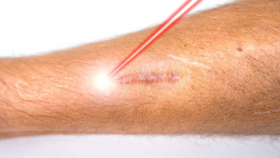 Kombinierte Lasertherapie bei hypertrophen Narben