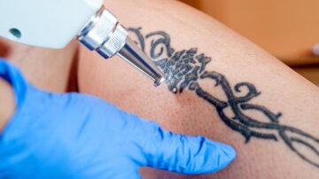 EADV: Nachbehandlung von Laserläsionen mit Dexpanthenol-haltiger Salbe. Bild: iStock