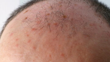 Nahaufnahme der Oberseite eines Männerkopfes. Zwischen den bereits spärlichen Haaren sind rötliche Flecken. © pedrojperez | iStock