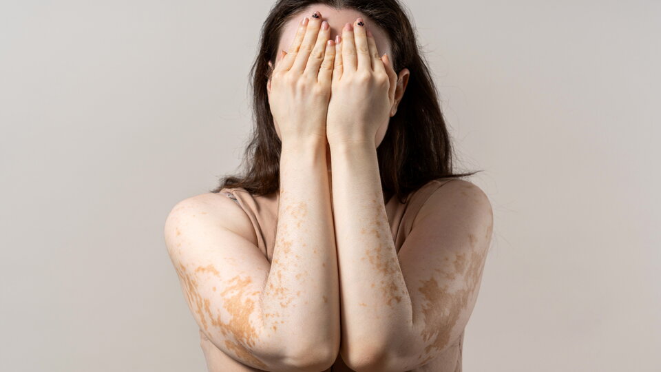 Junge Frau, die ihr Gesicht mit Händen bedeckt und Vitiligo an Armen und Schultern zeig