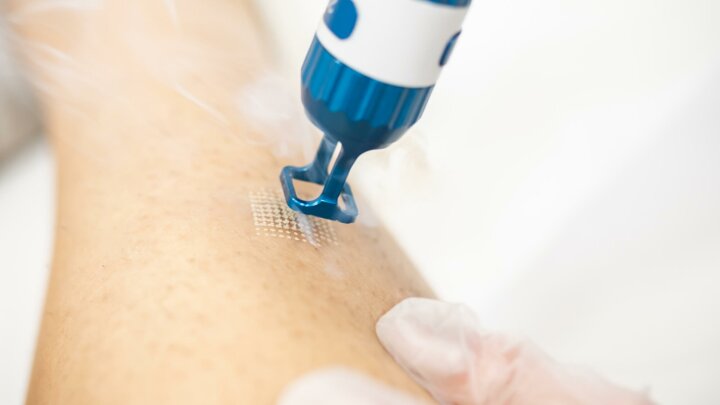 Ablativer Laser © AdobeStock