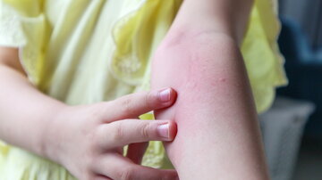 Kleines Mädchen hat Hautausschlag, Allergie und Juckreiz auf ihrem Arm
