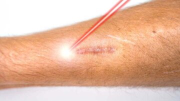 Kombinierte Lasertherapie bei hypertrophen Narben