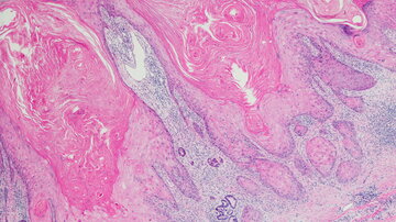 Keratinizing Squamöse cell Karzinom von der Haut weg