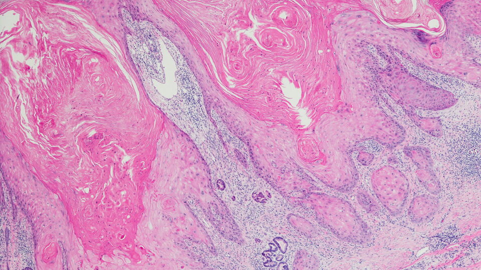 Keratinizing Squamöse cell Karzinom von der Haut weg
