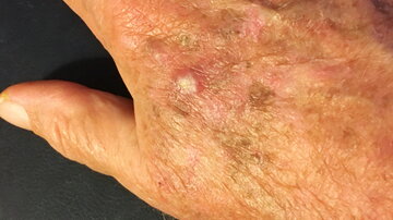 Aktinische Keratose auf einem Handrücken