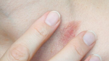 Pityriasis lichenoides