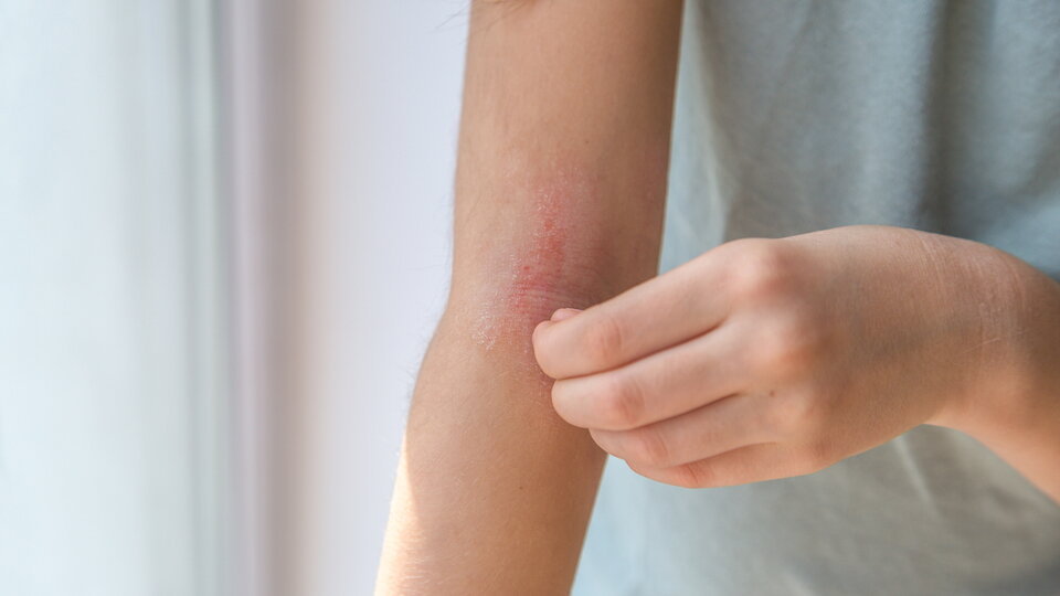 Ein Mädchen kratzt sich an der Haut am Armellenbogen, die Rötung ist eine atopische Dermatitis, das Gesicht des Mädchens ist nicht sichtbar