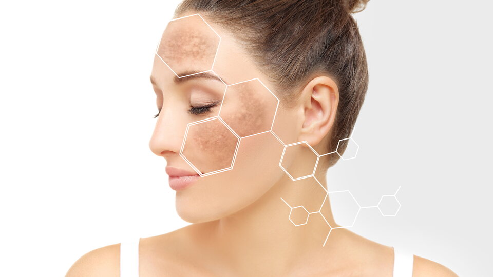Tranexansäure plus Lasertherapie bei Melasma