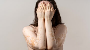 Junge Frau, die ihr Gesicht mit Händen bedeckt und Vitiligo an Armen und Schultern zeig