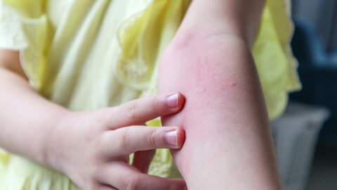 Kleines Mädchen hat Hautausschlag, Allergie und Juckreiz auf ihrem Arm