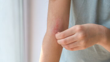 Ein Mädchen kratzt sich an der Haut am Armellenbogen, die Rötung ist eine atopische Dermatitis, das Gesicht des Mädchens ist nicht sichtbar