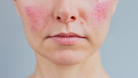 Porträt einer jungen Frau, die im akuten Stadium an Rosacea im Gesicht leidet