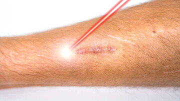 Kombinierte Lasertherapie bei hypertrophen Narben
